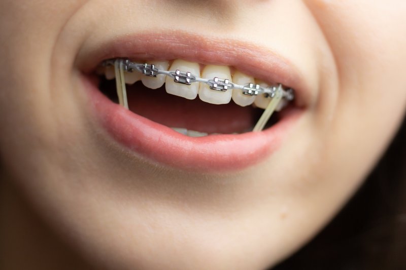 How Do Rubber Bands Help With My Braces?